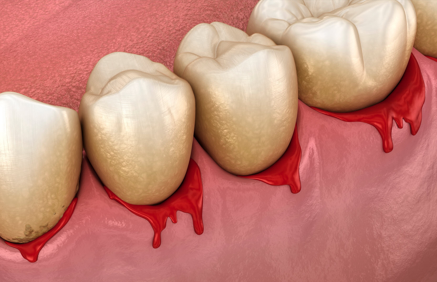 Dental Check-Up: Regular dental visits can help diagnose and treat issues such as bleeding gums early.