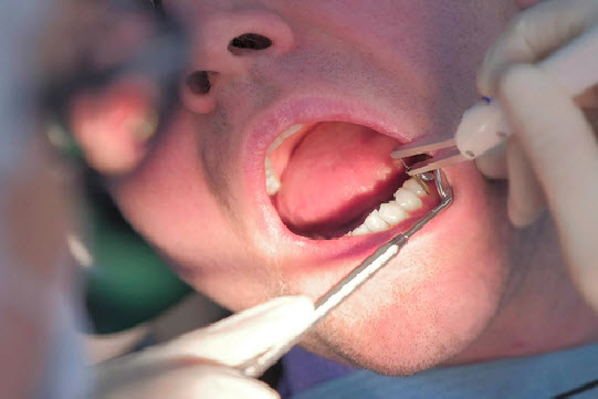 Treatment of Gum disease in Brisbane