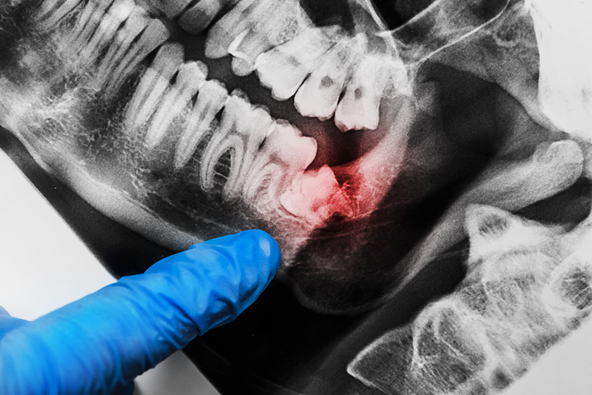 General Anesthesia-assisted dental extraction Stress-free tooth extraction with sedation in Brisbane