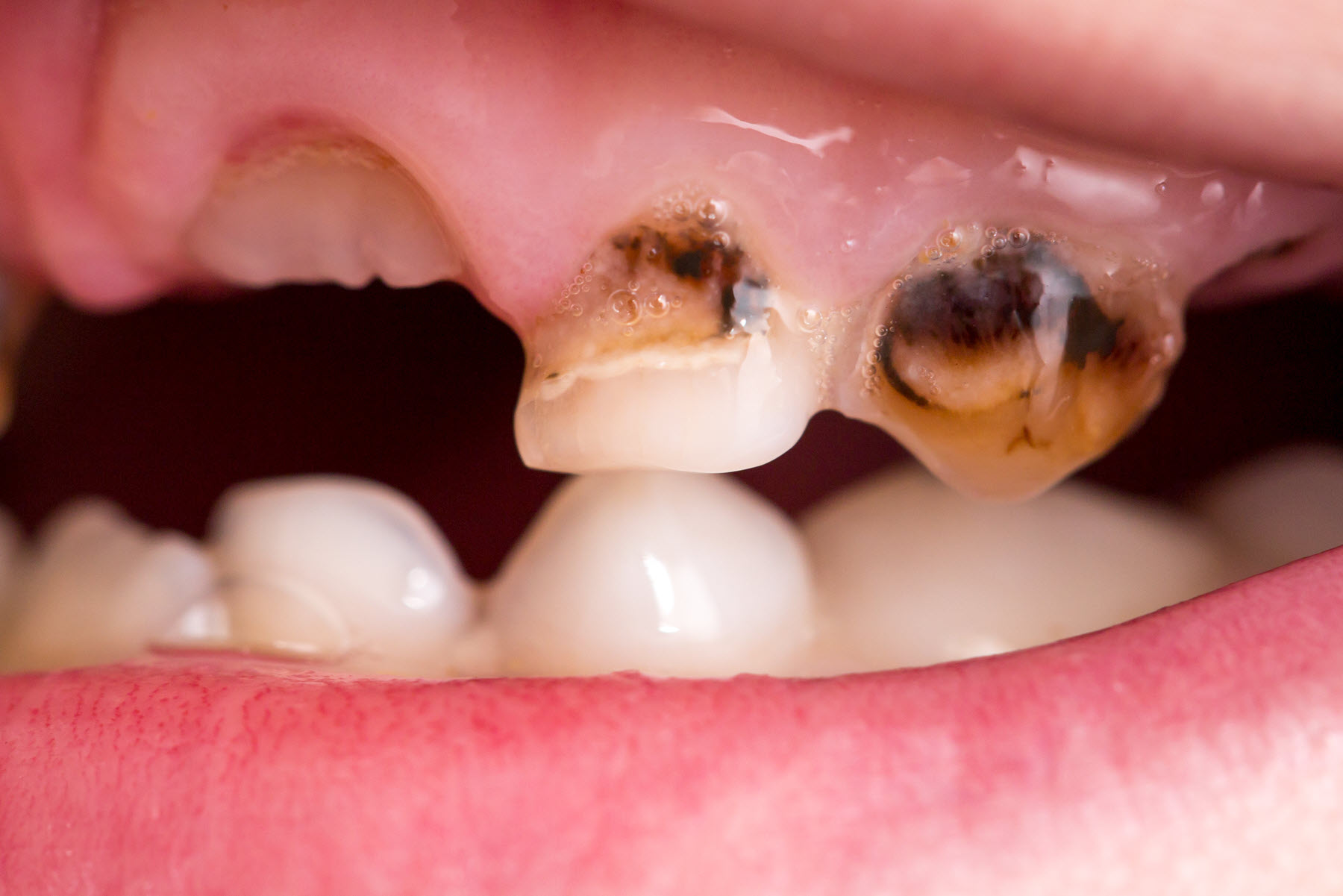 treatment of cavities on baby teeth in Brisbane