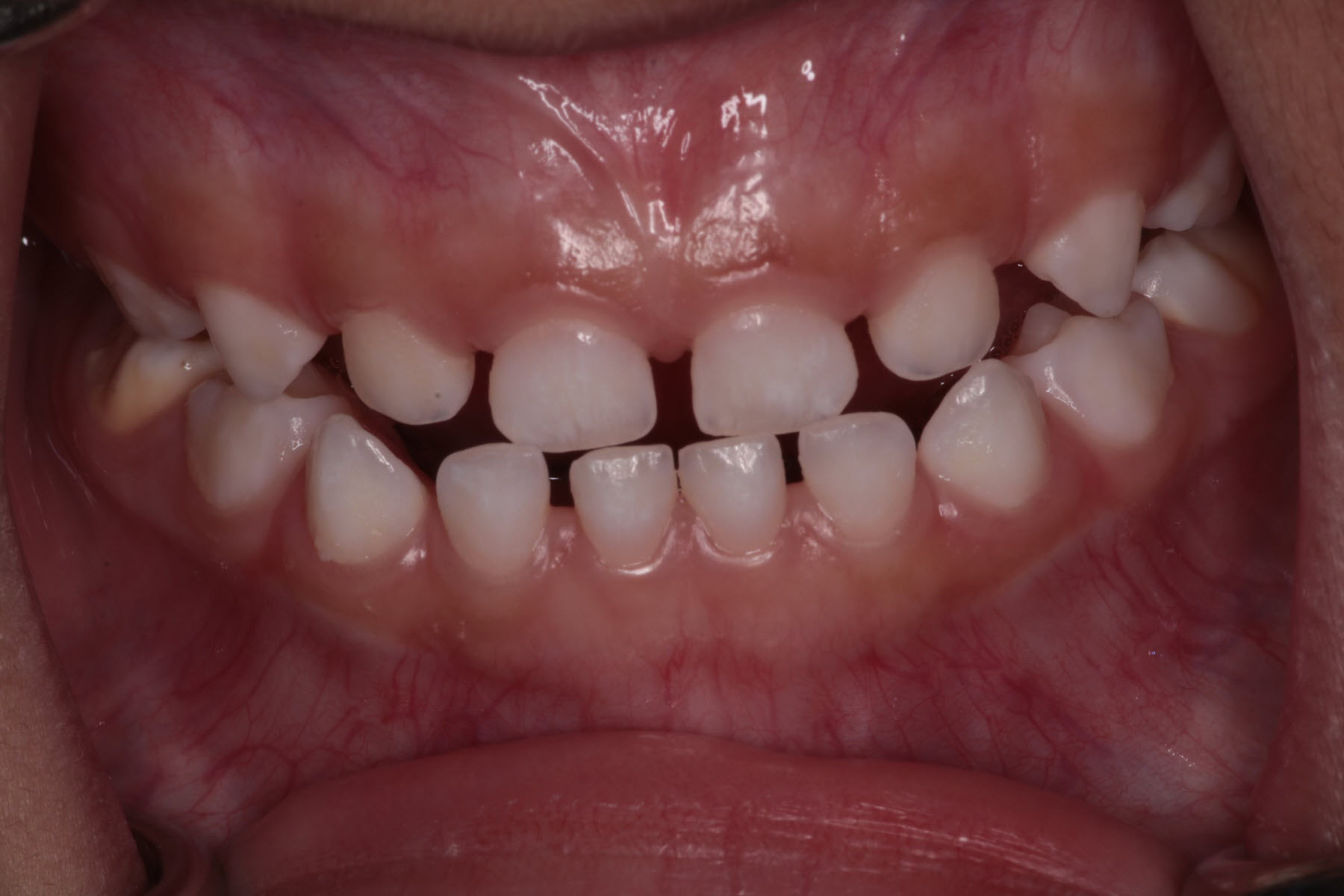 These spots could be developmental defects of enamel, known as enamel hypoplasia or hypomineralisation of baby teeth