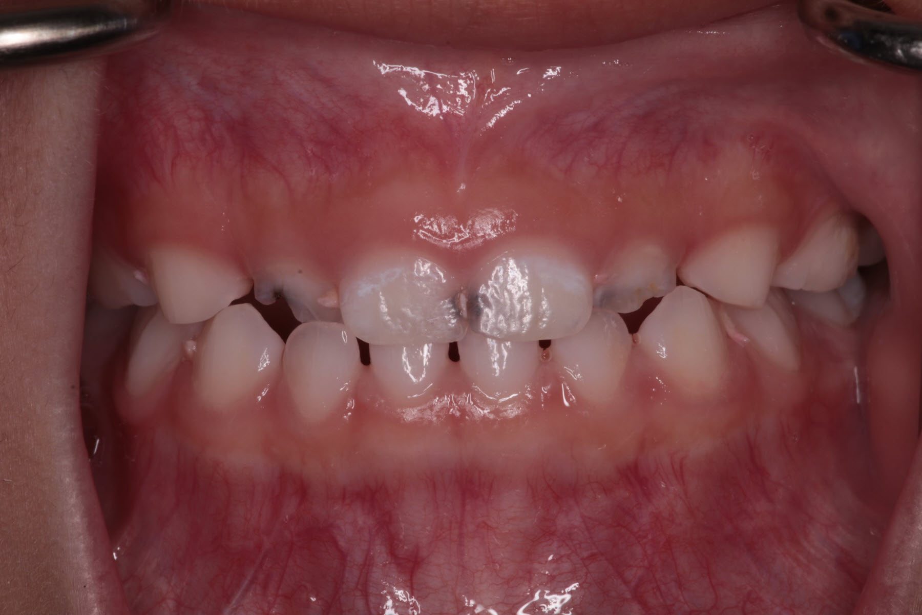 the start of caries on baby teeth