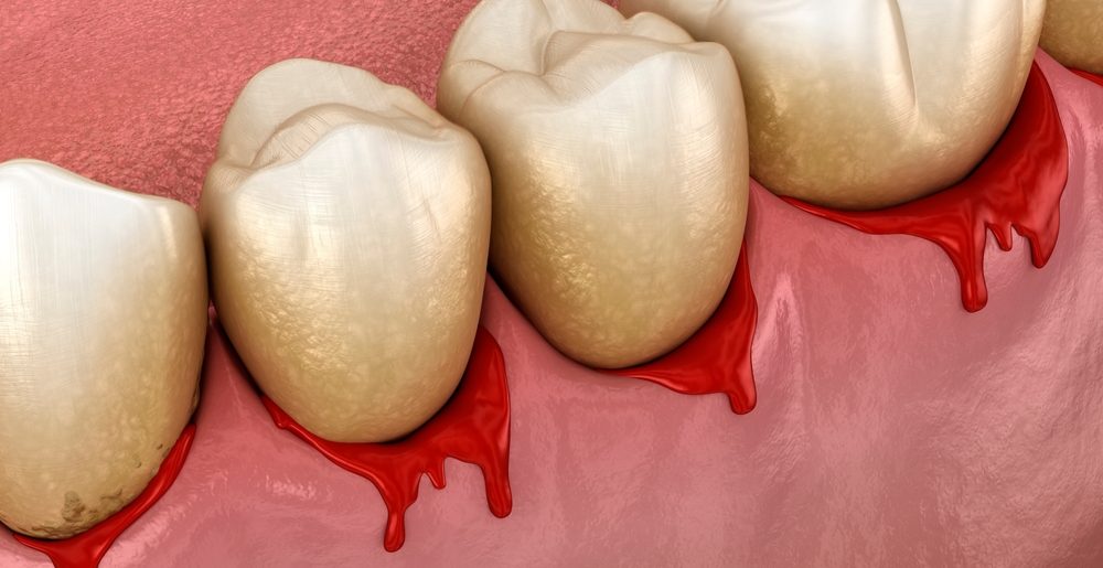bleeding gums