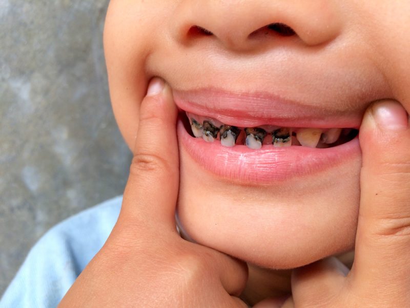 Child showing front teeth with severe tooth decay and multiple cavities