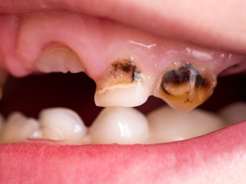 a child’s teeth showing cavities and decay near the gumline