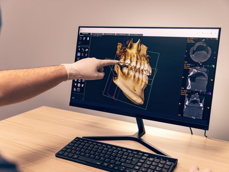 Dentist analyzing a 3D CBCT dental scan on a computer screen